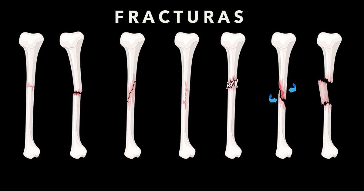 Fracturas Ortopedista en Tijuana Síntomas Causas y Tratamiento